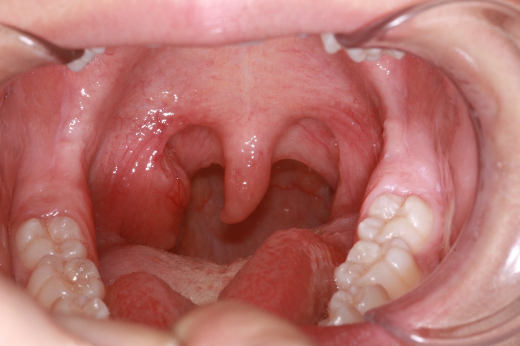 Enlarged Throat 75