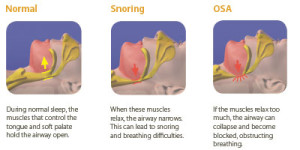 What Causes Sleep Apnea