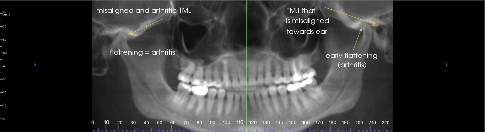 Temporomandibular Joint X Ray